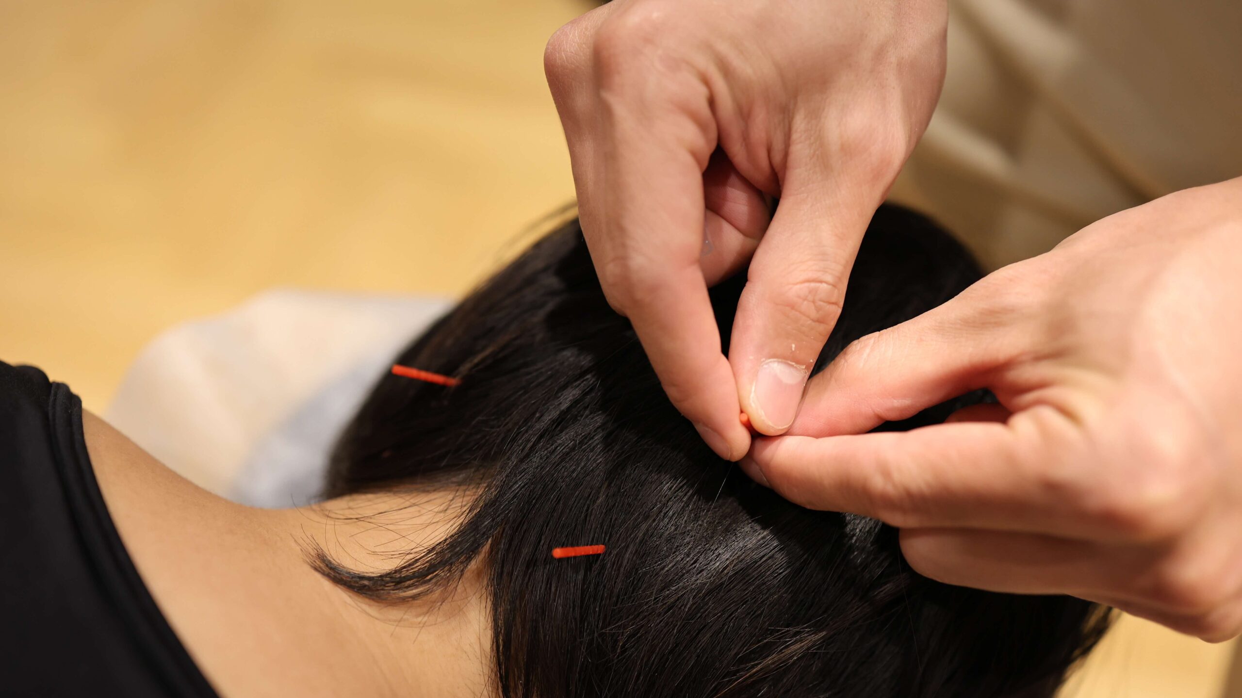 Acupuncture